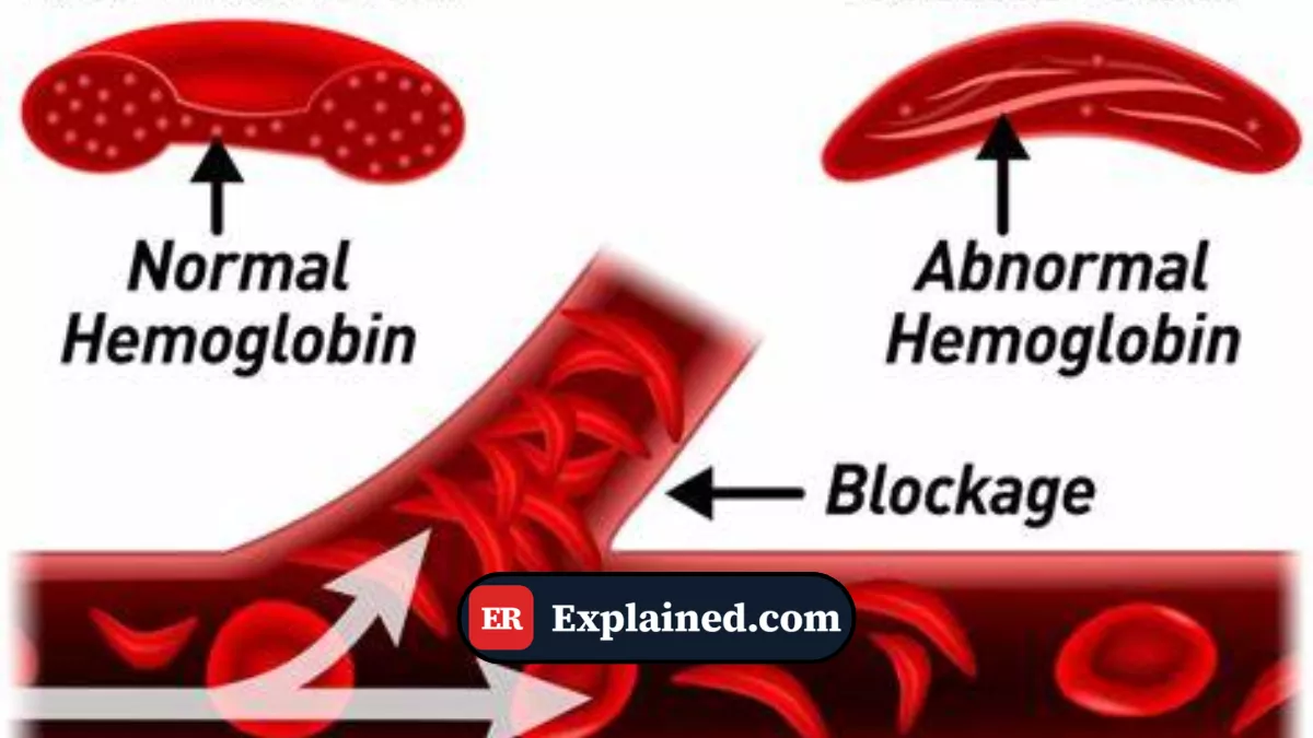 Síndrome Torácica Aguda: A Complicação Letal da Anemia Falciforme