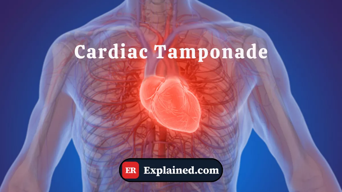 Tamponamento Cardíaco: O Que É e Por Que É uma Emergência Absoluta