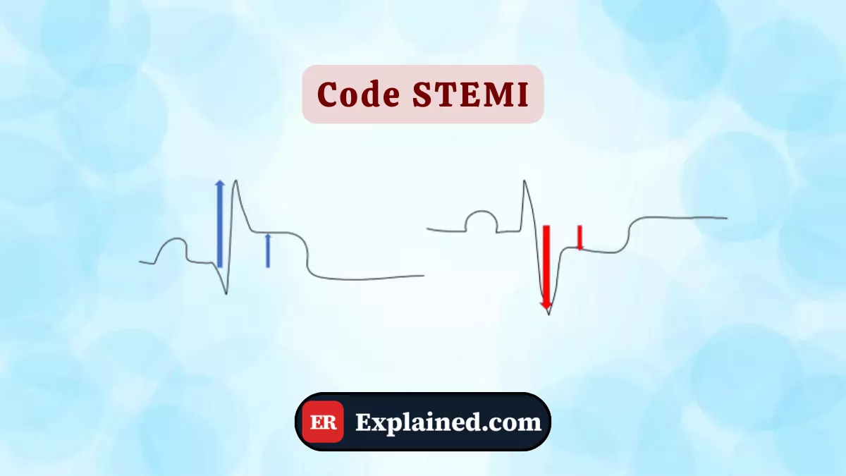 Código STEMI: A Corrida de 51 Minutos Para Salvar um Coração