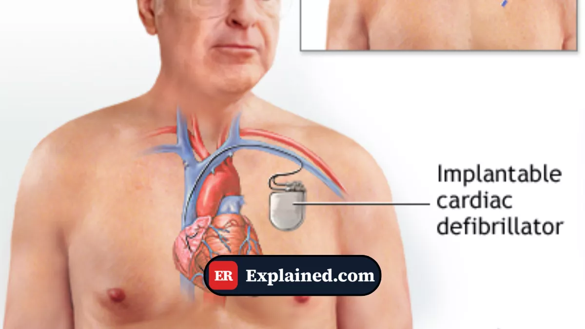 Defibrillator and Cardioverter: What They Are and How They Save Lives in the ER