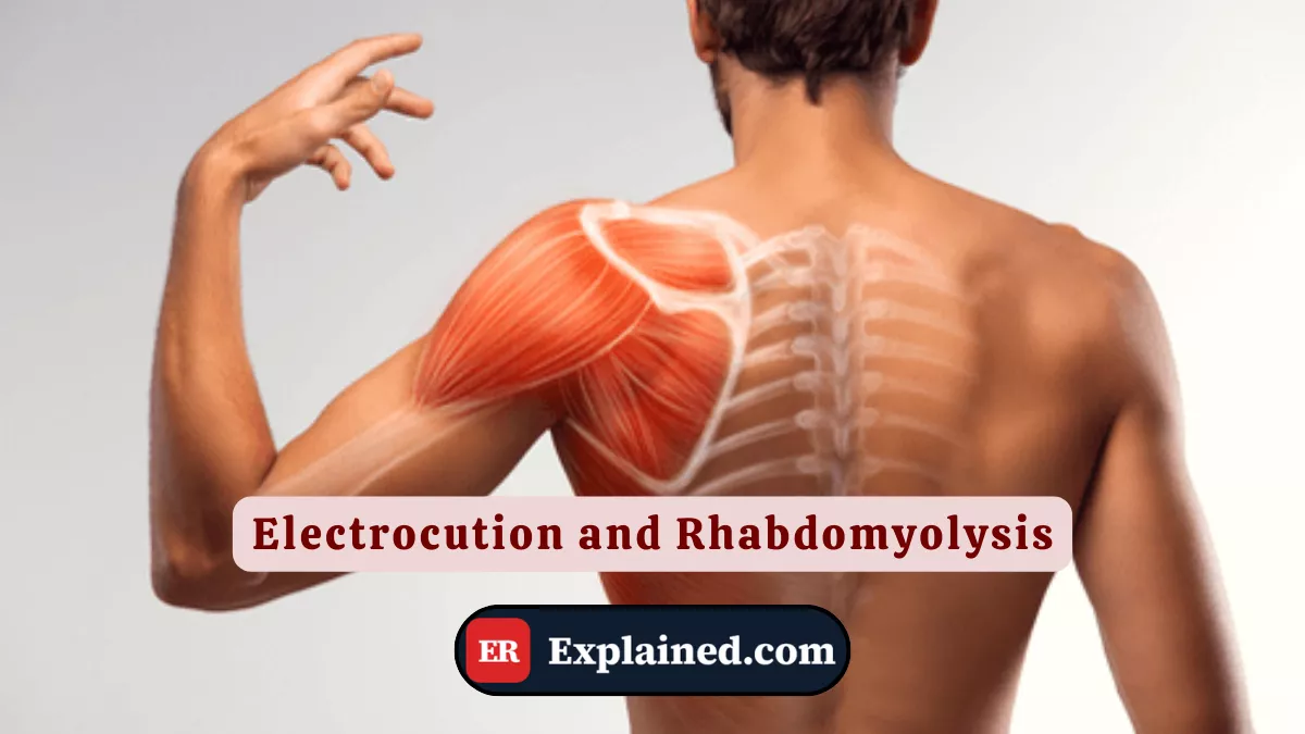 Eletrocussão e Rabdomiólise: O Choque Que Derrete Músculos