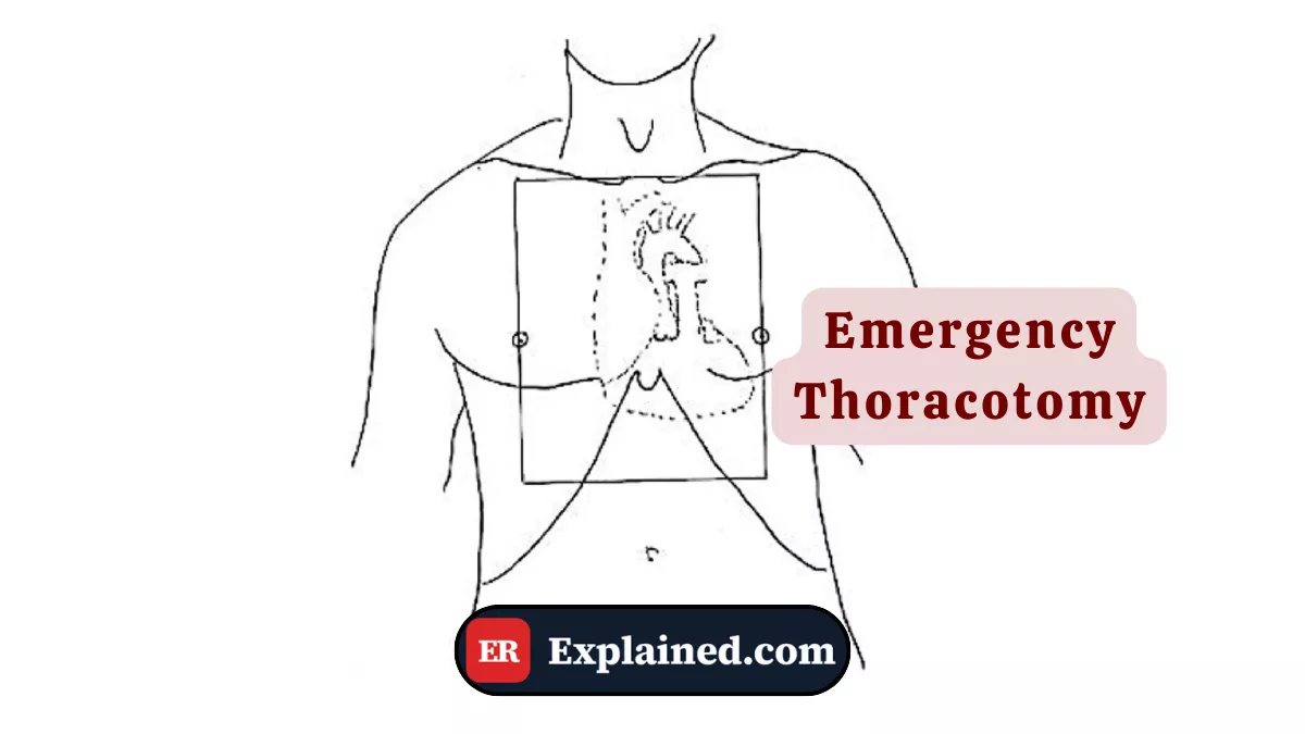 Toracotomia de Emergência: Quando o Tórax É Aberto no Próprio Pronto-Socorro