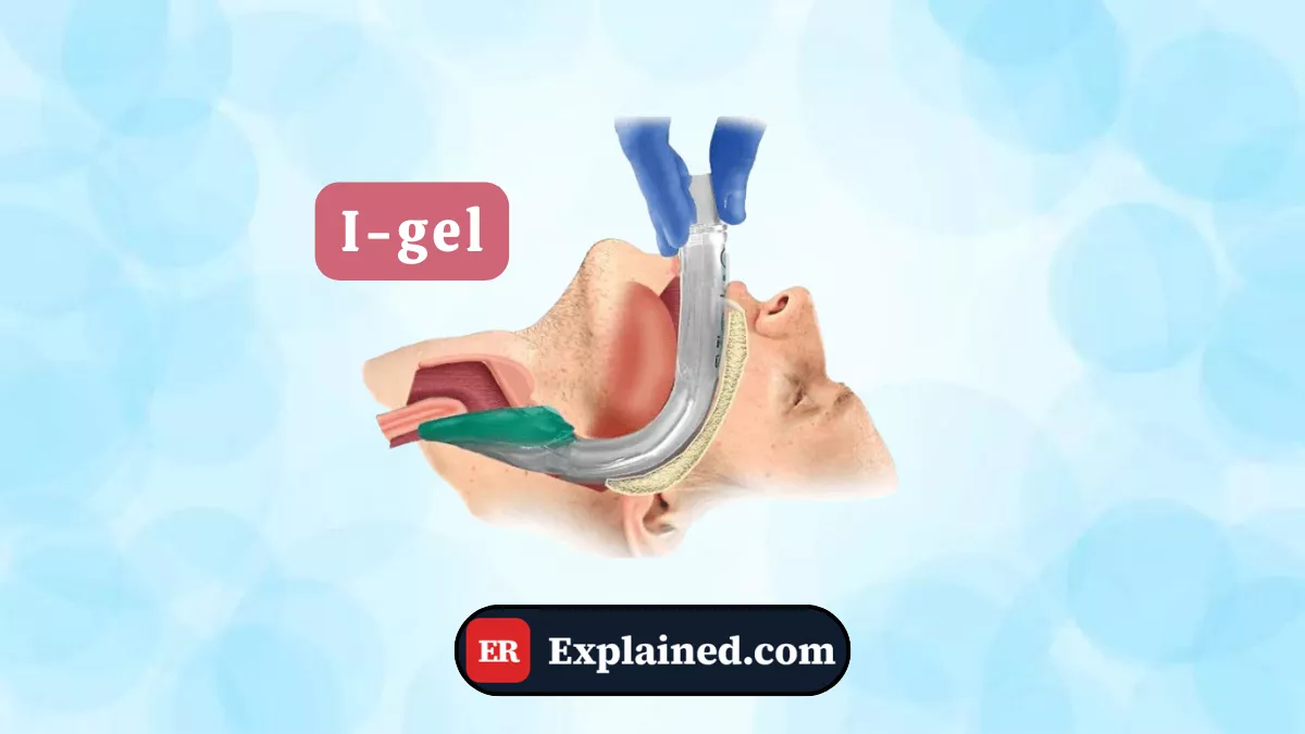 I-gel: The Supraglottic Rescue Airway