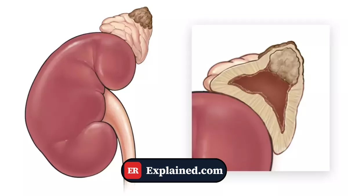 Feocromocitoma: O Tumor Que Dispara Adrenalina