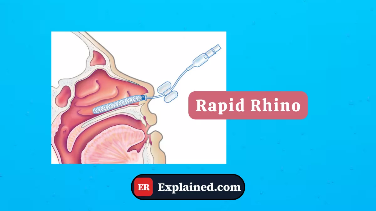 Rapid Rhino: The Nasal Balloon for Severe Bleeding