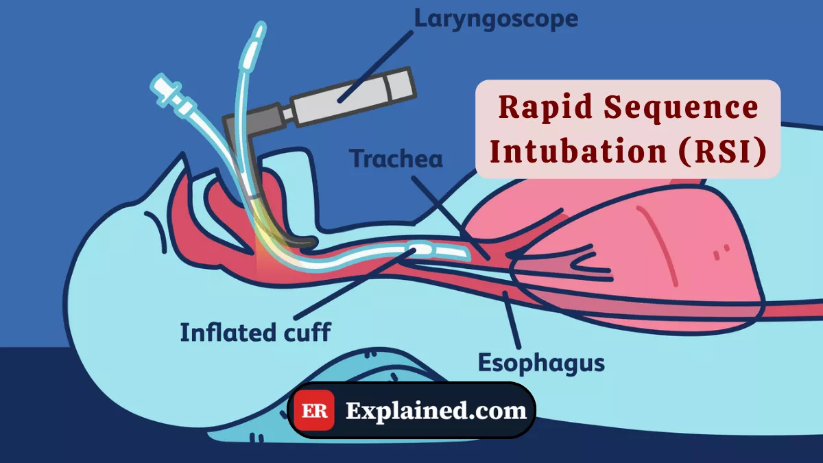 Intubação de Sequência Rápida (ISR): O Protocolo Padrão para Vias Aéreas de Emergência